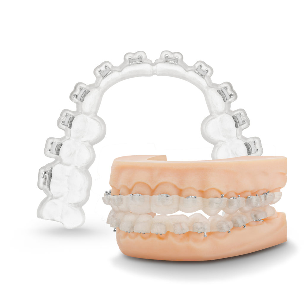 Indirect Bonding Inquiries - TP Orthodontics